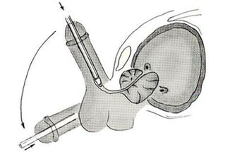 Schéma endoskopickej operácie na zväčšenie penisu