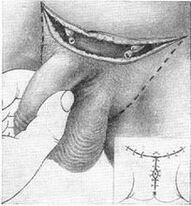 Chirurgické predĺženie penisu vytiahnutím jeho skrytej časti