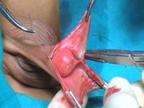 Operácia na zväčšenie mužského penisu
